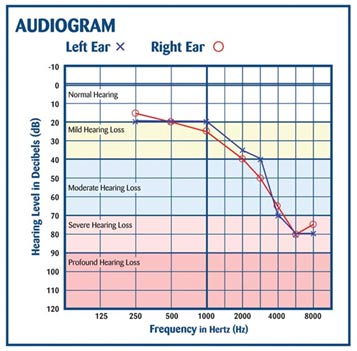 audiogram